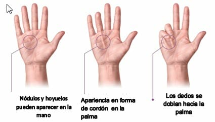 Contractura de Dupuytren