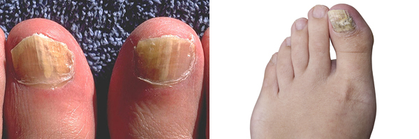 Onychomycosis (Nail Fungus)