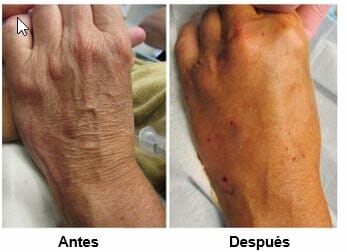 Rejuvenecimiento de Manos con Injertos de Grasa vs Rellenos