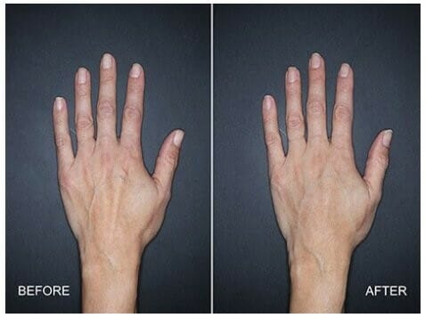 Hand Rejuvenation with Fat Grafting vs Fillers