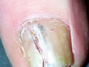 Subungual Melanoma