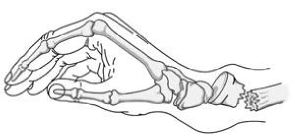 Fracturas del radio distal (Fractura de muñeca)