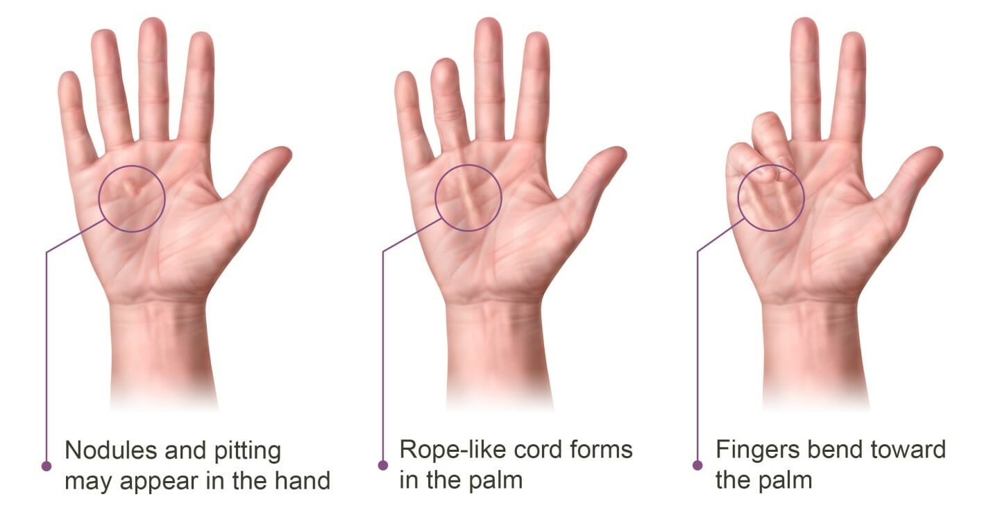 Dupuytren’s Contracture