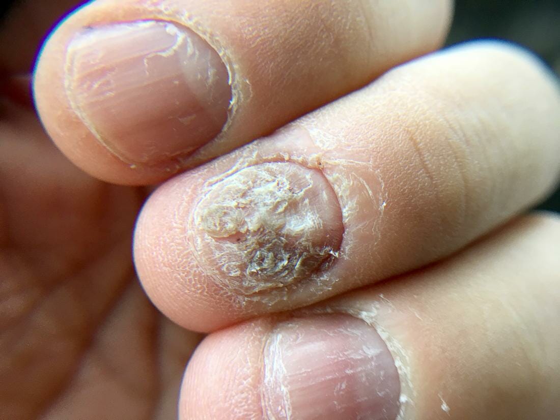 Onychomycosis (Nail Fungus)