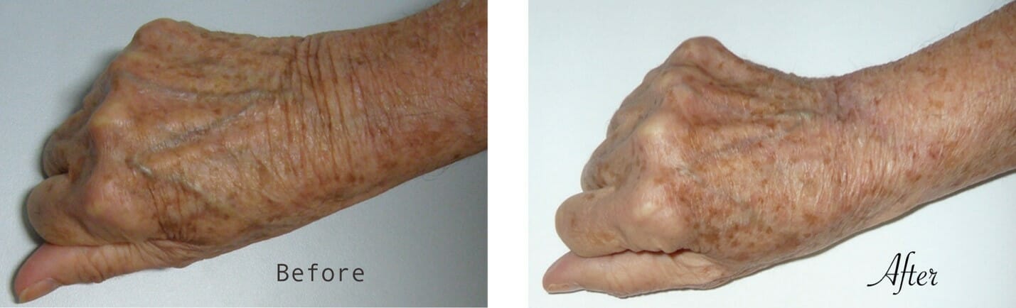 Surgical Handlift