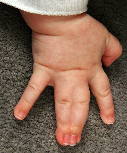 Syndactyly