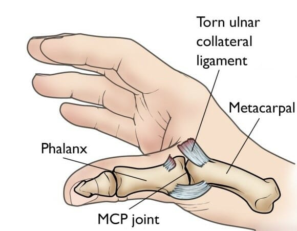 Syndactyly