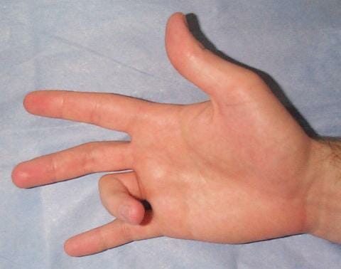 Trigger Finger