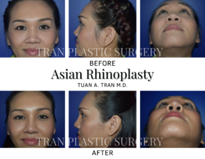 Tran Plastic Surgery - Asian Rhinoplasty