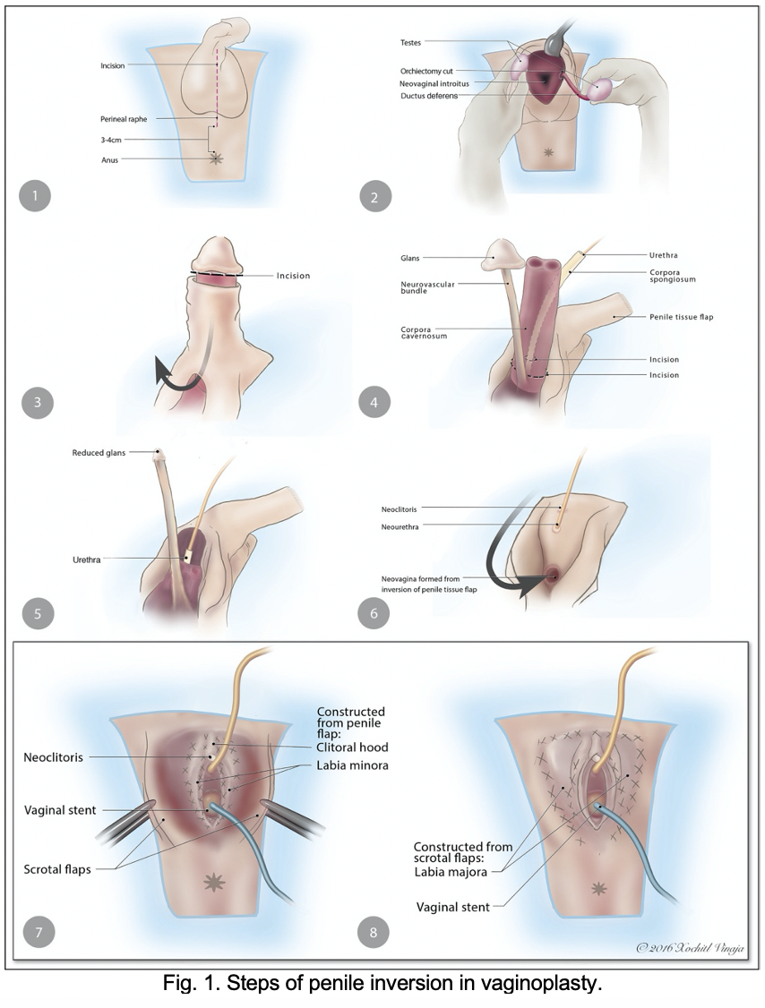 Post Op Vaginoplasty Post Op Vaginoplasty